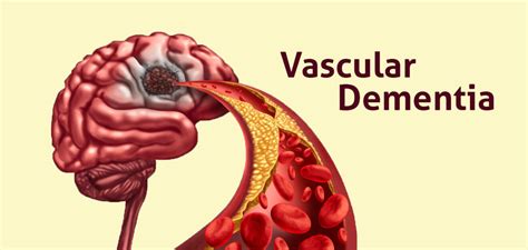 A breathless brain: navigating vascular dementia | Happiest Health