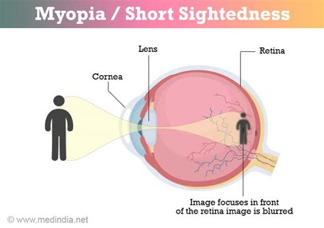 Myopia - Symptoms and Diagnosis - Treatment - FAQs