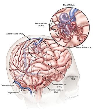 Arteriovenous Malformation (AVM) - Nashville Neurosurgery Associates