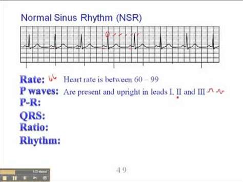 ECG: Normal Sinus Rhythm (NSR) - YouTube