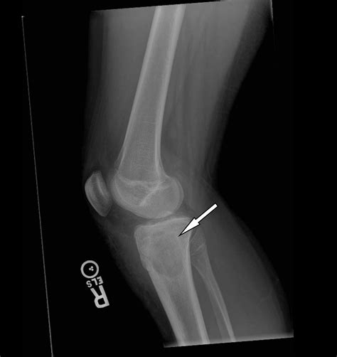 Cureus | A Case of Brodie’s Abscess With Tibial Erosion and ...