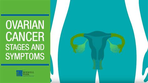 Understanding Ovarian Cancer Stages and Symptoms - YouTube