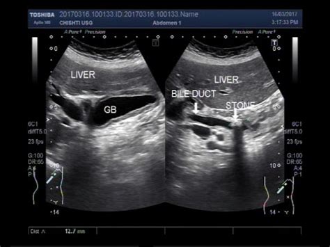 Ultrasound Video showing tracing of a stone in bile duct. - YouTube