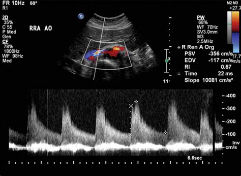 Buscar a tientas discreción Monótono renal artery duplex ultrasound ...