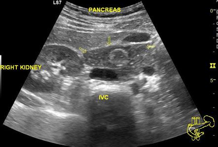 Pancreas Ultrasound