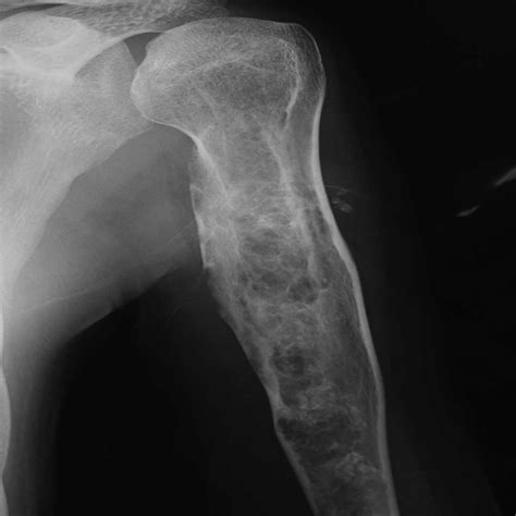 Enchondroma Proximal Humerus