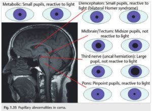 Neuro-ophthalmology Question of the Week: Neuro-ophthalmology Coma Eye Exam — Neuro-Ophthalmology