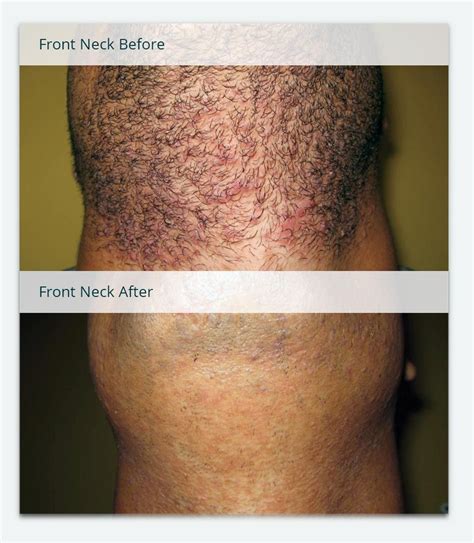 Before & After Photos of Laser Hair Removal | Milan Laser Ingrown Hair Removal, Ingrown Hairs ...