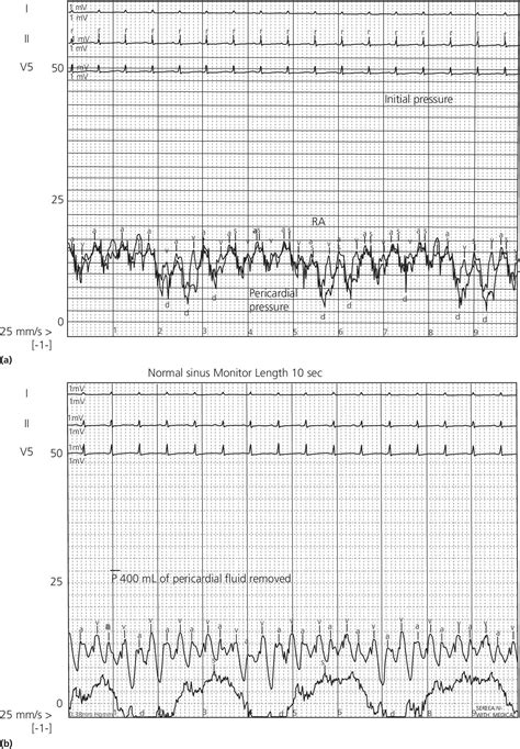 Cardiac Tamponade Ecg