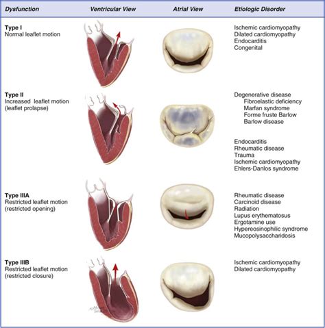 Identification and Quantification of Degenerative and Functional Mitral ...