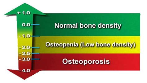 Bone Density Chart: Understand Your Bone Density Scores - University Health News Osteoporosis ...