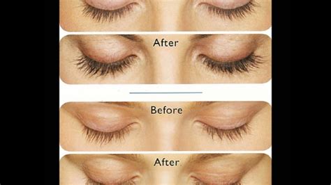 Latisse (Bimatoprost) Eyelash Growth: Before and After - YouTube