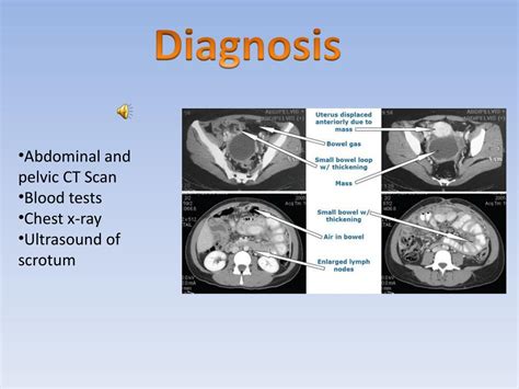 PPT - Testicular Cancer PowerPoint Presentation, free download - ID:2123134