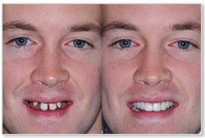 Dental Implant Before and After Photos