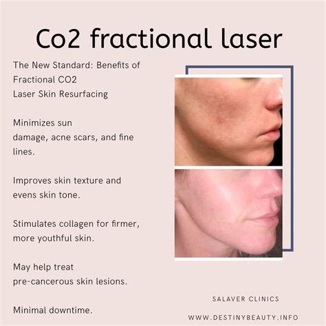 What Does Fractional CO2 Laser... - Salaver Clinic - Boracay | Facebook