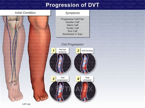 Progression of DVT - TrialQuest Inc.