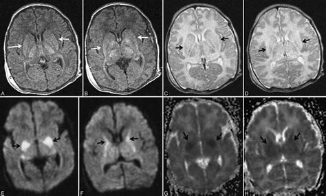 (A-H): A 12-day-old full-term neonate; HIE stage II-severe hypoxic ...