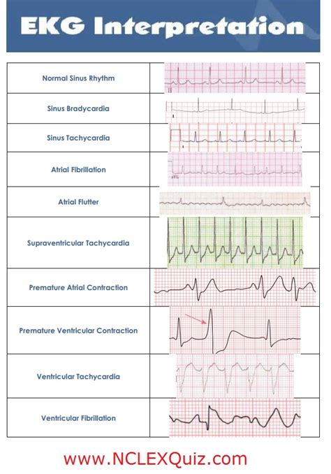 10 Common Heart Rhythms Cheat Sheet - NCLEX Quiz