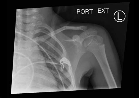 Pediatric Clavicle Fracture - JETem