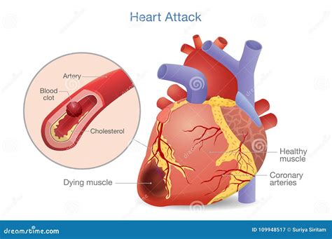 Illustration of Arterial Thrombosis is a Blood Clot that Develops To Heart Attack. Stock Vector ...