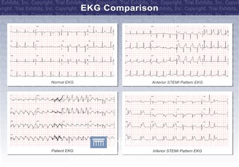 EKG Comparison - TrialQuest Inc.