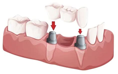 Dentadura postiza: ¿Cuánto cuesta? Tipos y precios de dentaduras