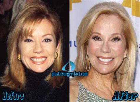 Kathie Lee Gifford Plastic Surgery Before and After