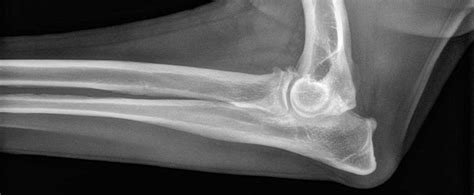 Elbow Dysplasia - Fitzpatrick Referrals