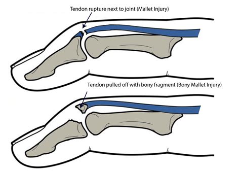 Mallet Injuries – Aberdeen Virtual Hand Clinic