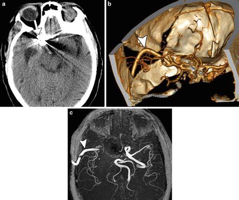 Postop Evaluation of Aneurysms (Including Vasospasm) | Radiology Key