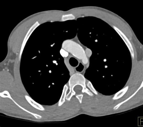 Persistent Left SVC / CTisus.com | Case study, Cardiac, Medical imaging