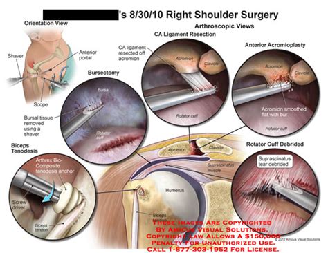 AMICUS Illustration of amicus,surgery,shoulder,shaver,scope,portal,bursal,tissue,bursectomy ...