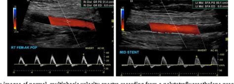 Figure 1 from Interpretation of arterial duplex testing of lower-extremity arteries and ...