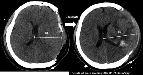 Axial brain CT scan showing brain swelling on postoperative day 7. The... | Download Scientific ...