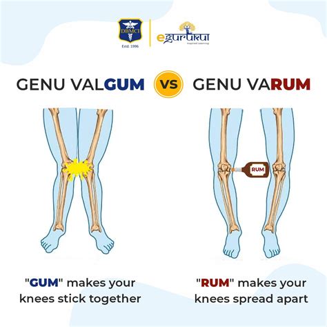 Genu Varum And Valgum: Causes, Symptoms, And Effective, 56% OFF