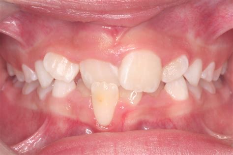 anterior crossbite - Iowa City Orthodontics