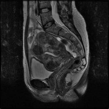 Uterus Anatomy Mri