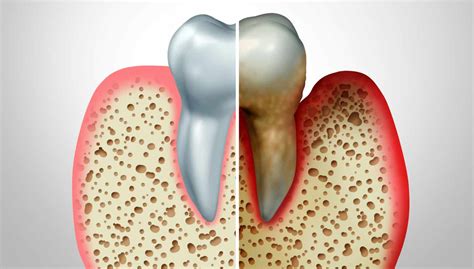 Dental Bone Loss Causes & Prevention | Smith Dentalworks