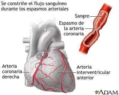 INFARTO AGUDO AL MIOCARDIO - Mind Map