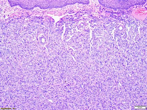 Pathology Outlines - Dermatofibroma (cutaneous fibrous histiocytoma)