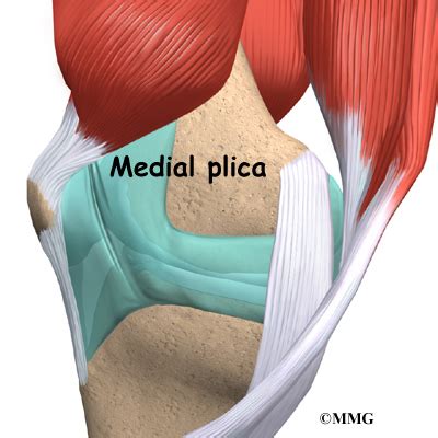 Plica Syndrome | Orthogate