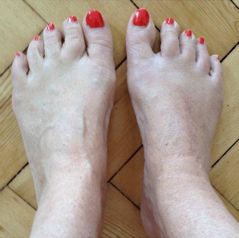 Do I have Midfoot Arthritis?: Castle Rock Foot & Ankle Care: Podiatrists