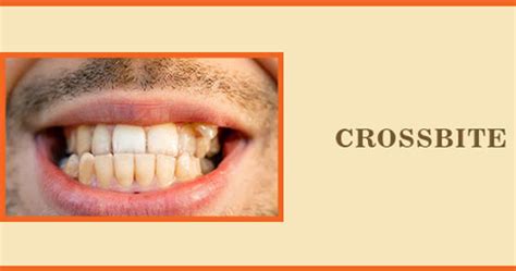 Crossbite Solutions: Uncover Symptoms, Causes & Treatment