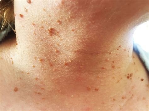 12 Bumps On Your Skin That Are Totally Normal—And You Shouldn't Pop | Pulse Nigeria