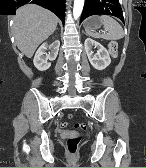 Right Renal Angiomyolipoma - Kidney Case Studies - CTisus CT Scanning