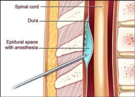 Intrathecal Vs Epidural Injection