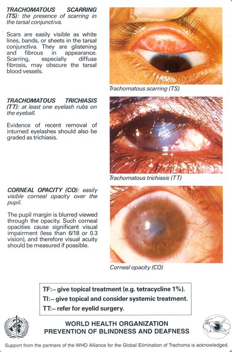 Trachoma