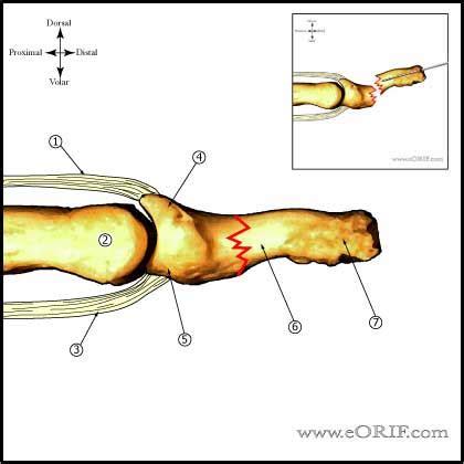 Distal Phalanx Fracture Classification | eORIF