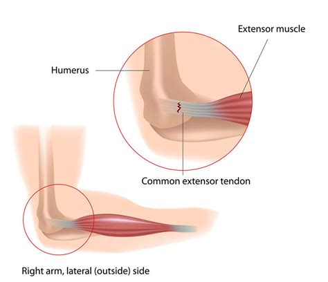 Flexor Tendonitis Of The Elbow: Anatomy, Symptoms, Causes Treatments ...