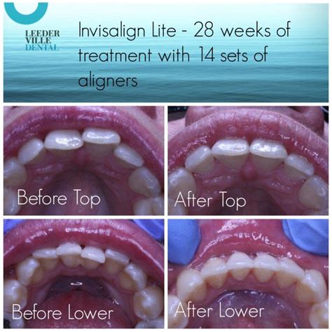 Invisalign Lite - before and after - Leederville Dental - Perth's most experienced sedation dentist